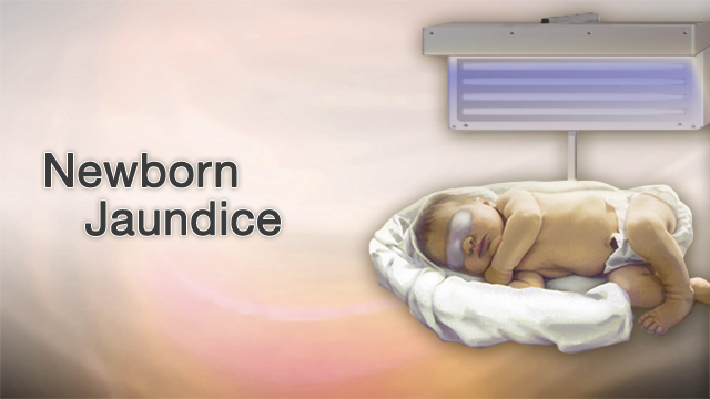 HIE Multimedia Jaundice and breastfeeding