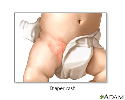 Diaper Rash Information | Mount Sinai - New York