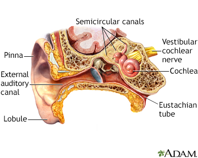 Malignant Otitis Externa