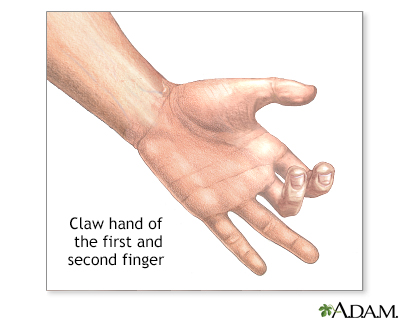 Claw hand Information | Mount Sinai - New York