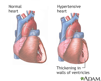 Hypertensive Heart Disease Information | Mount Sinai - New York