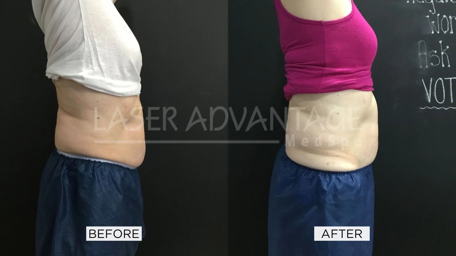 Before and After Gallery Laser Advantage