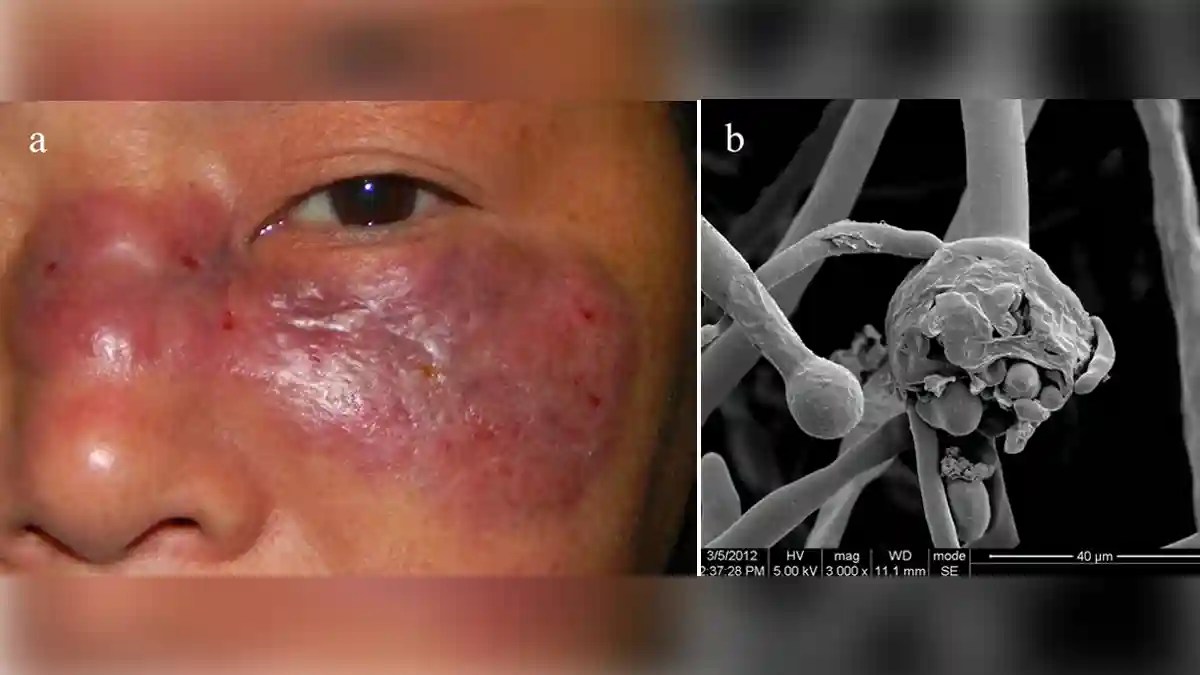 June 07, 2021 19:22 shyam a. Mucormycosis Causes, Symptoms, Risks, Diagnosis ...
