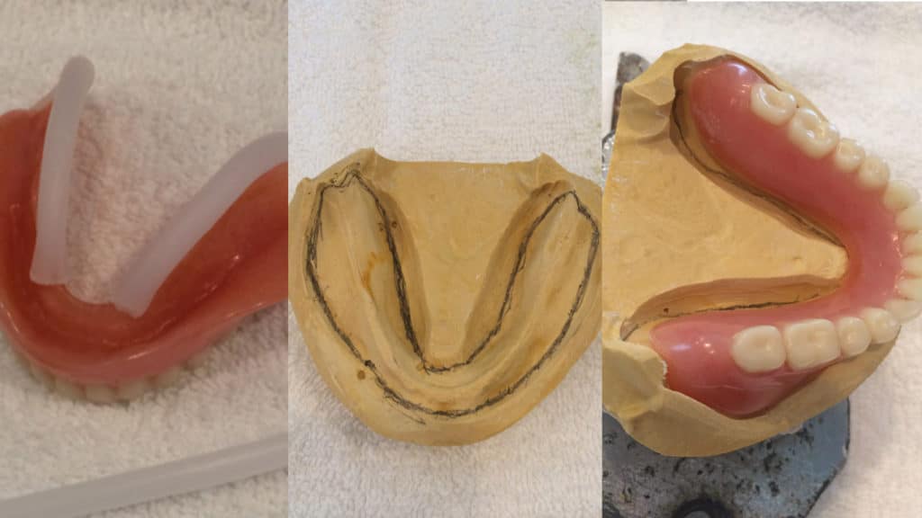 What You Need To Know To Get A Great Denture RelineStabilDent