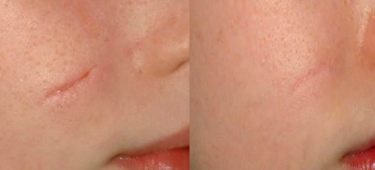 Treatments using laser procedures for Acne Scar Removal Stacyknows