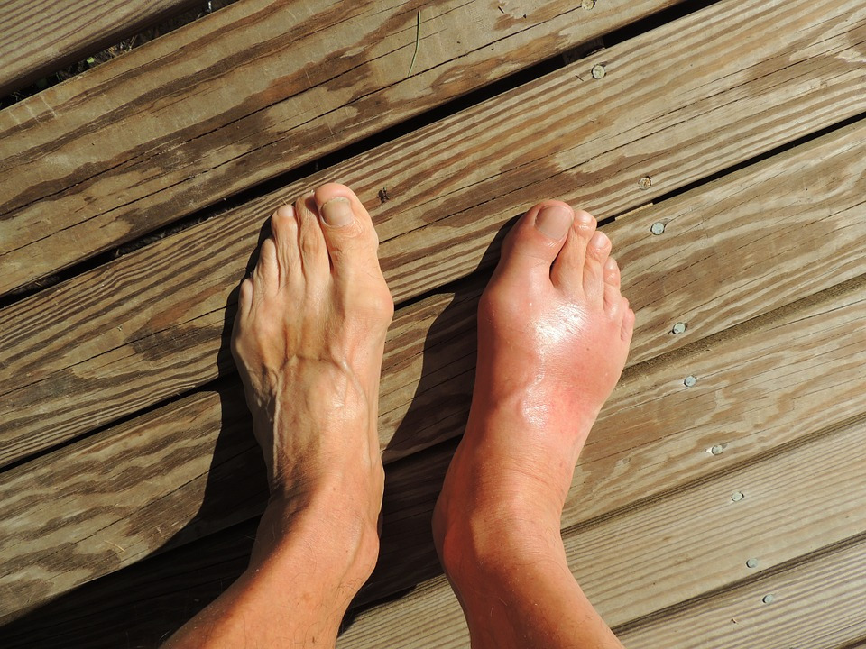 How To Treat Common Foot Injuries Without Any Complications Stacyknows