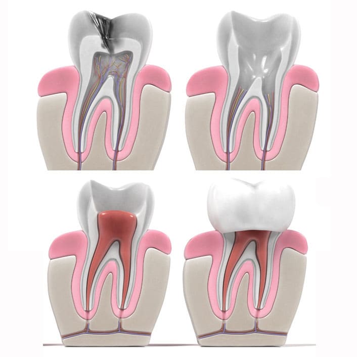 Root Canals Near Me in Kansas City, MO Staley Smiles Dental Care
