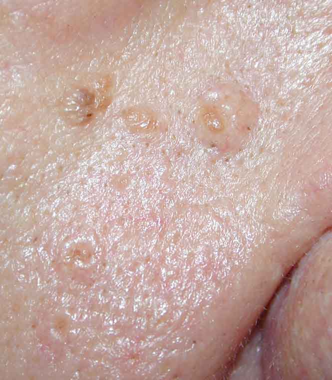 SEBACEOUS HYPERPLASIA Stamford Skin Centre