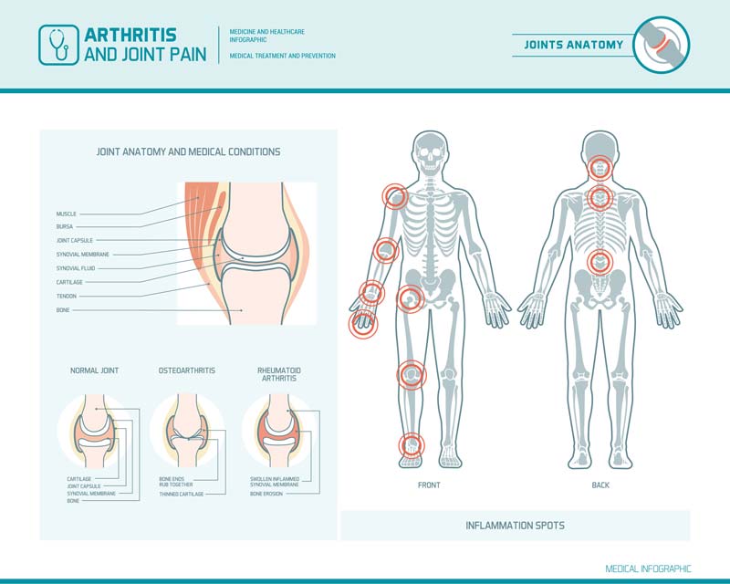 Arthritis & Joint Pains Chiropractor Plympton Chiro Adelaide Open