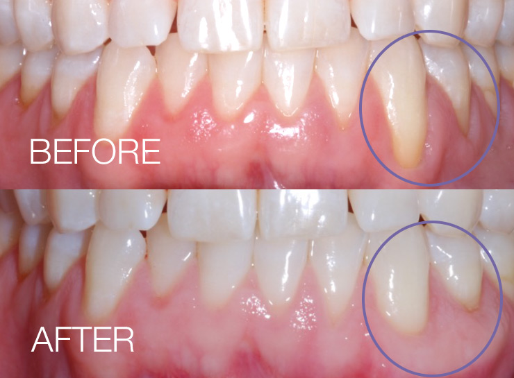 Soft Tissue Grafting Dr. Sasha Stasko