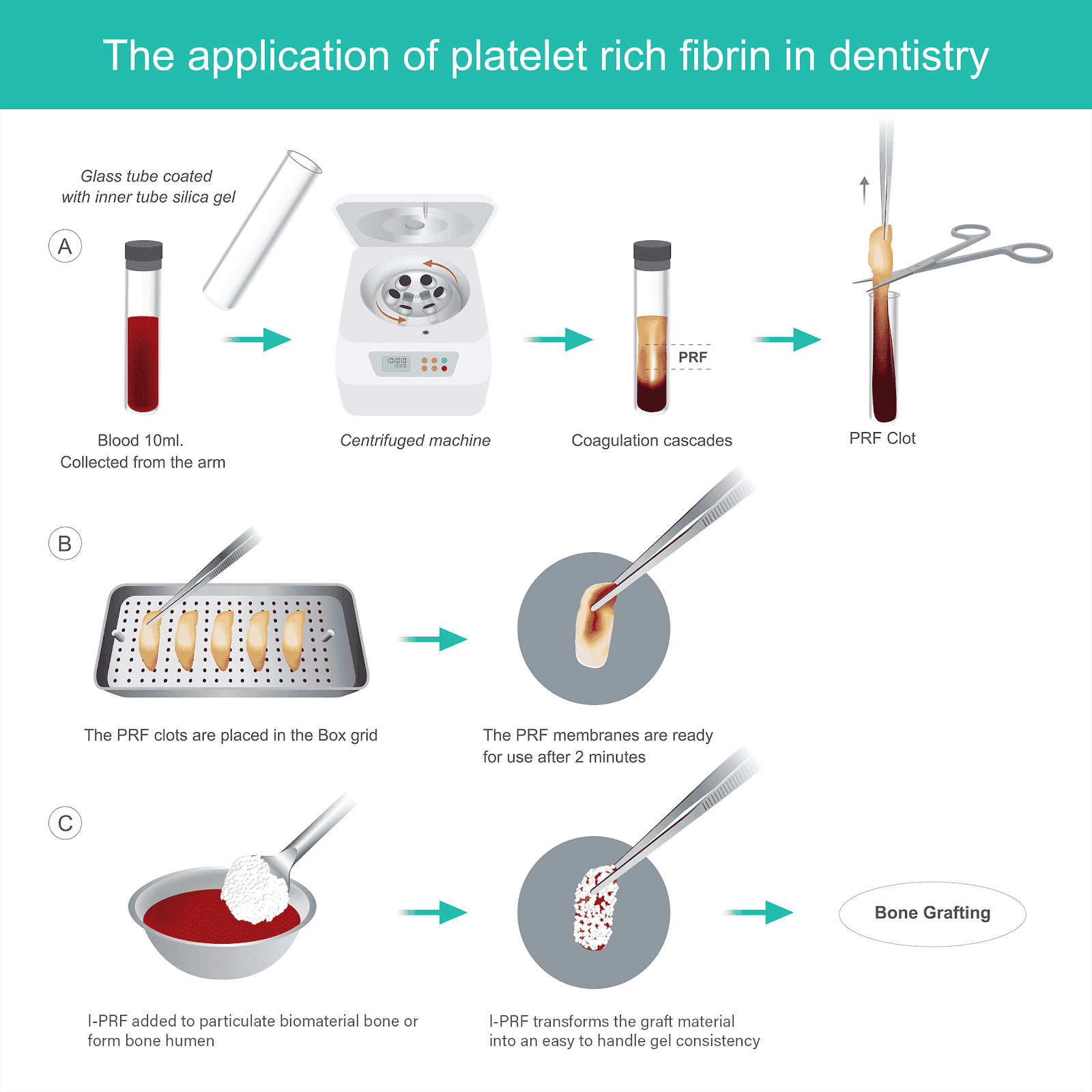 Platelet Rich Fibrin (PRF) Staten Island Oral Surgery