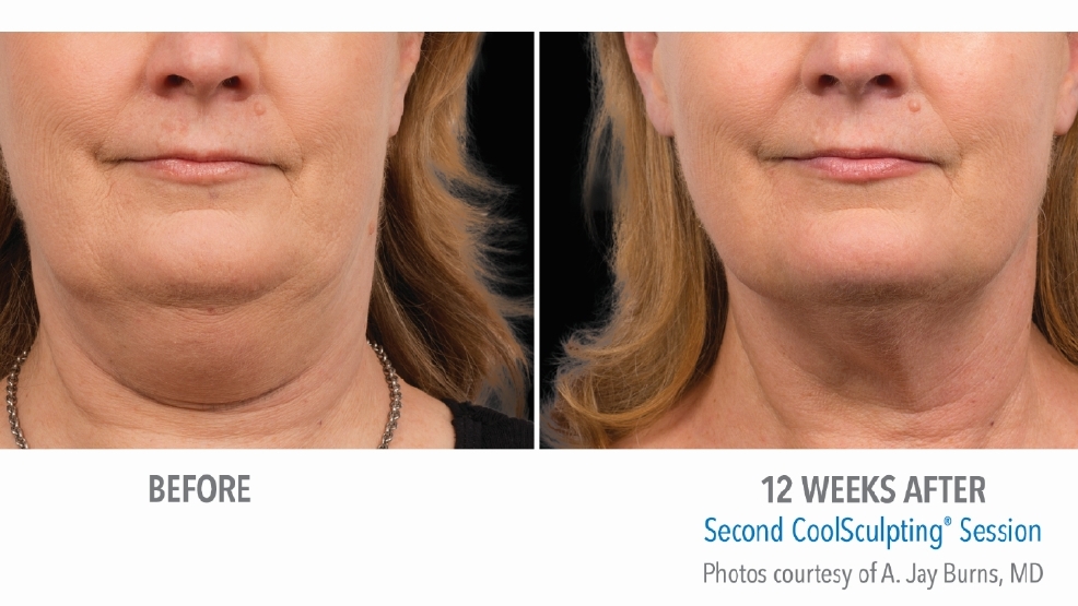 These are the 5 most popular noninvasive plastic surgery procedures in