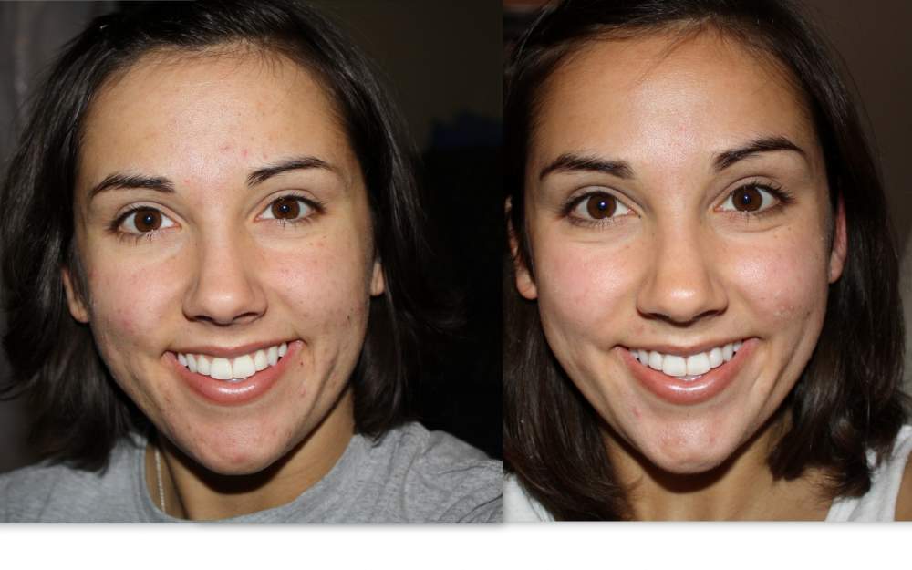 Member pictures Retin A and Ortho Tri Cyclen Front image 2