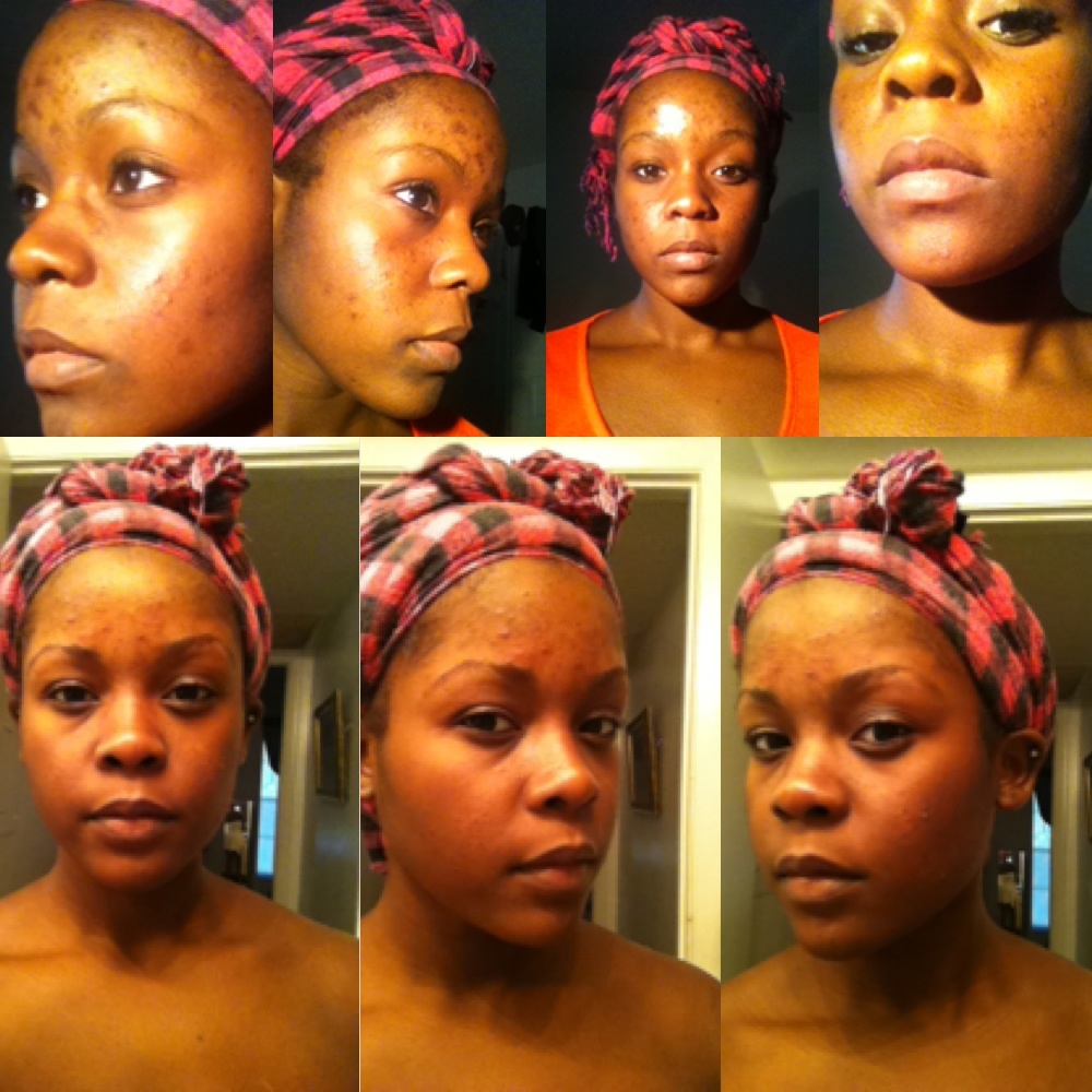 Acne scar recovery Member pictures