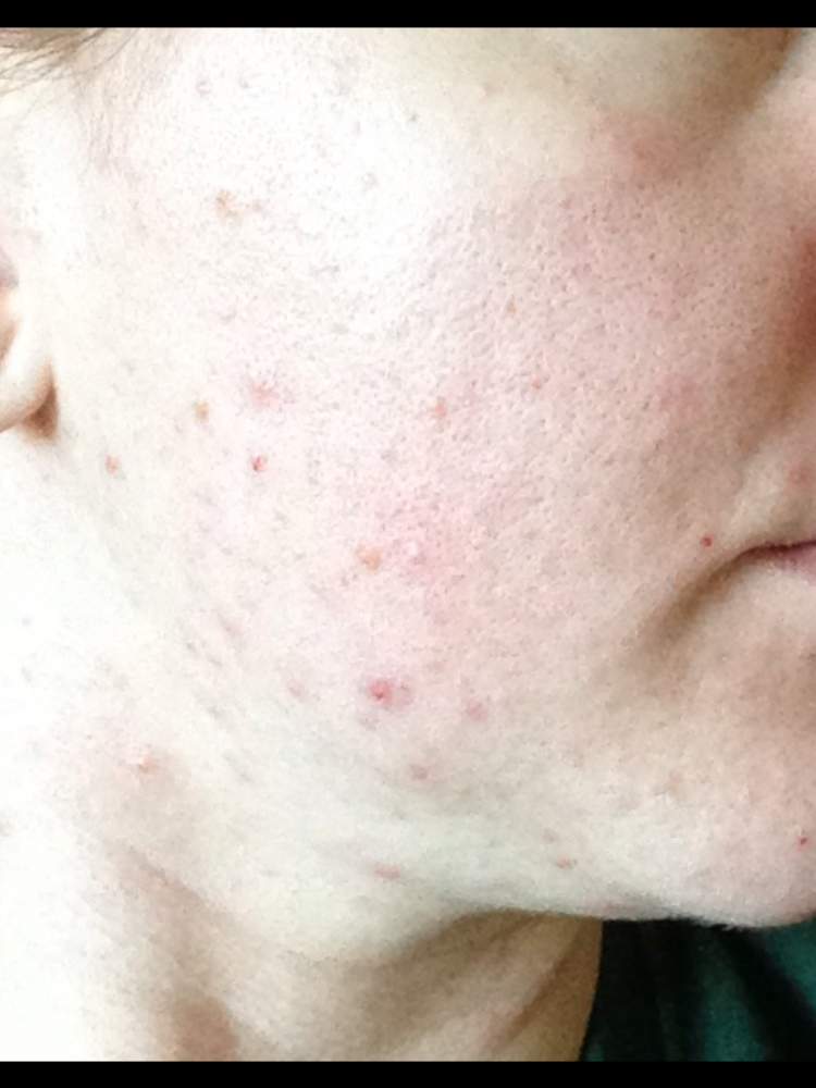 Acne Log