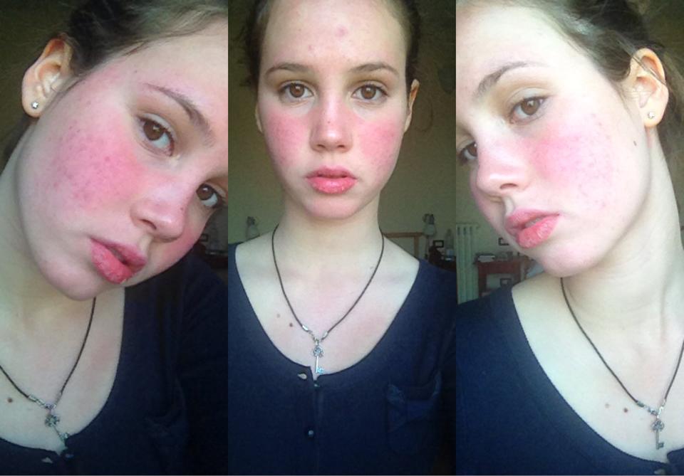 Plaquenil Induced Retinopathy, Plaquenil Eye Exam Report, Plaquenil