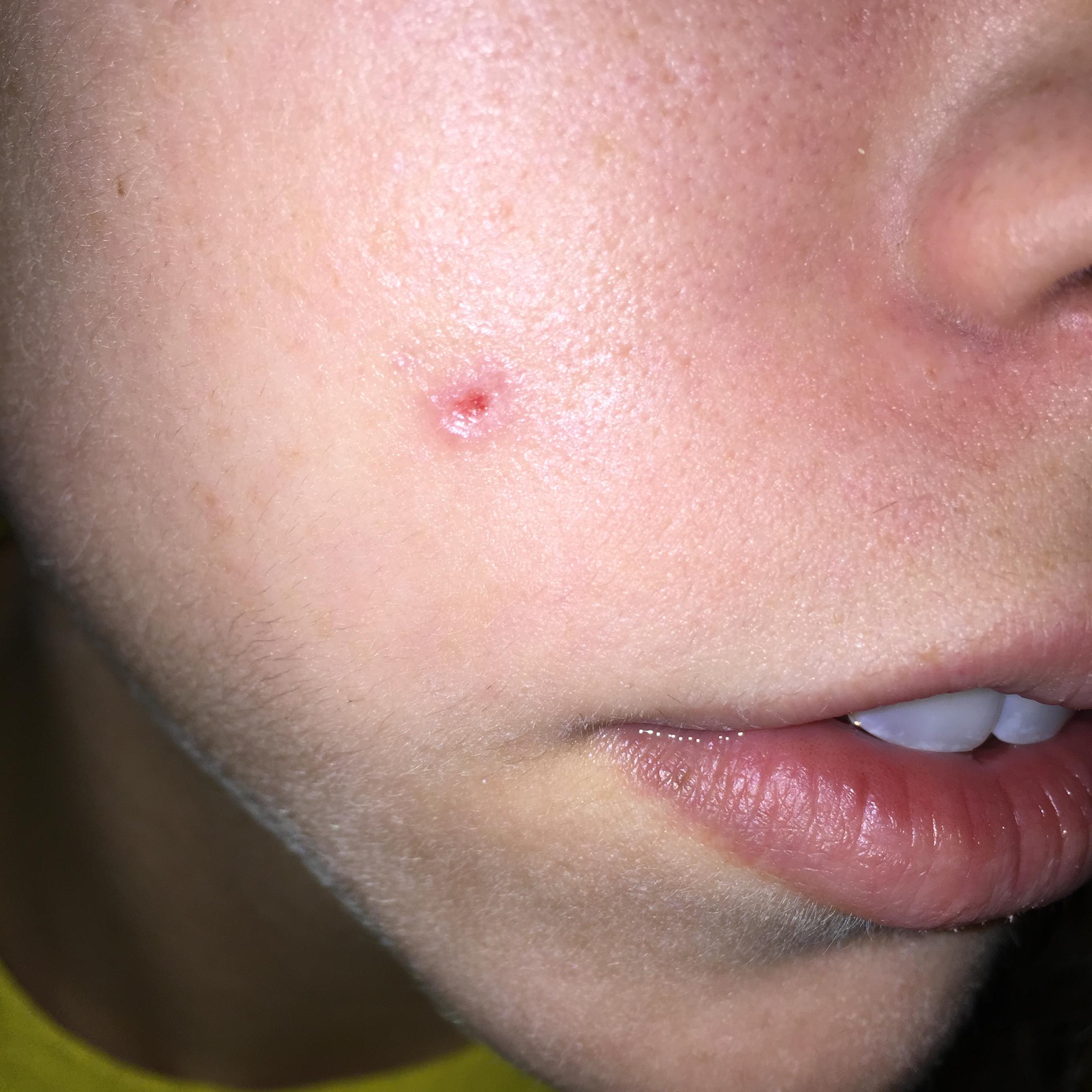 Hole from cystic acne! How long to heal?! General acne discussion