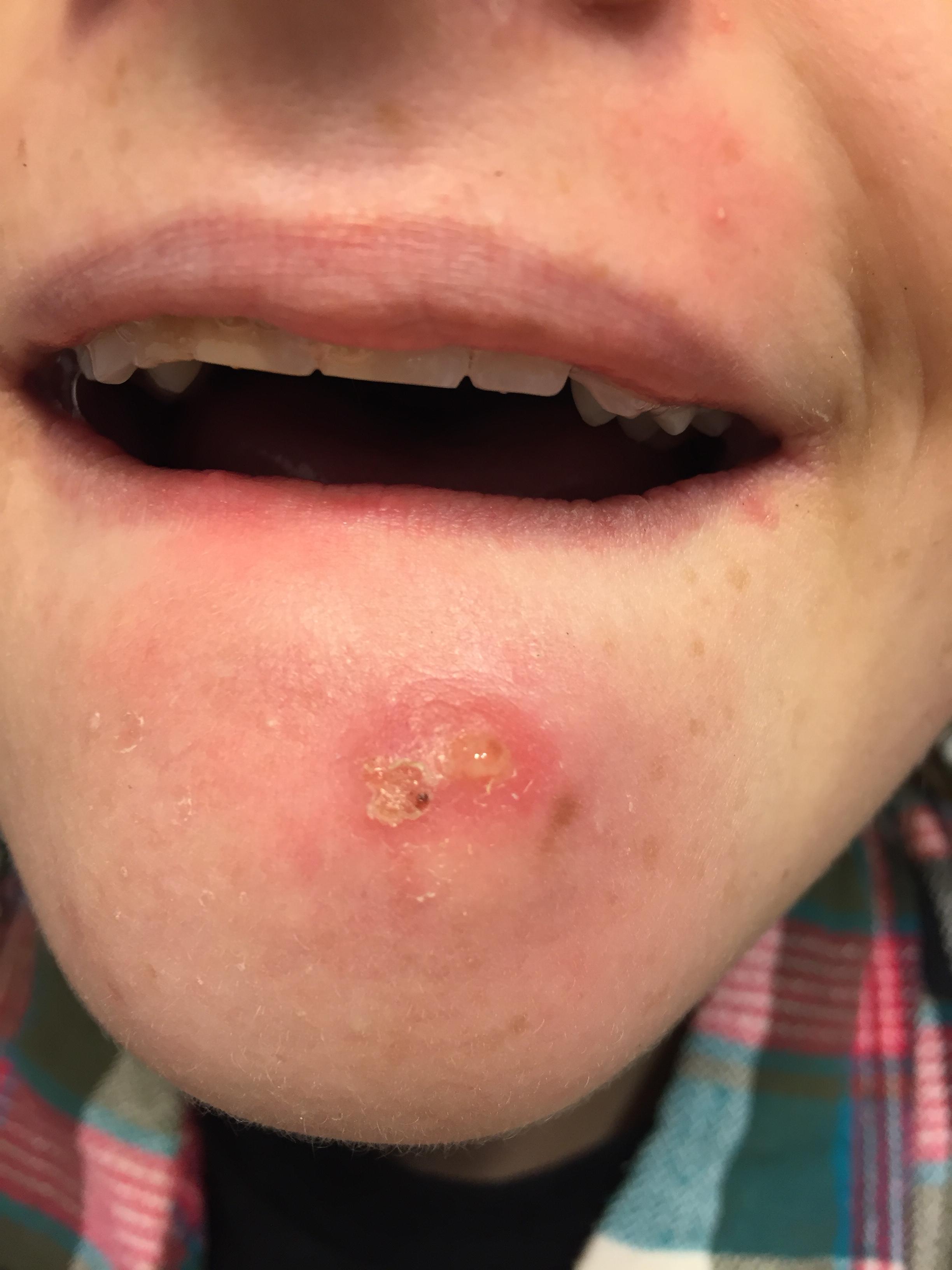 Awful under the skin double zit?? Back/Body/Neck acne