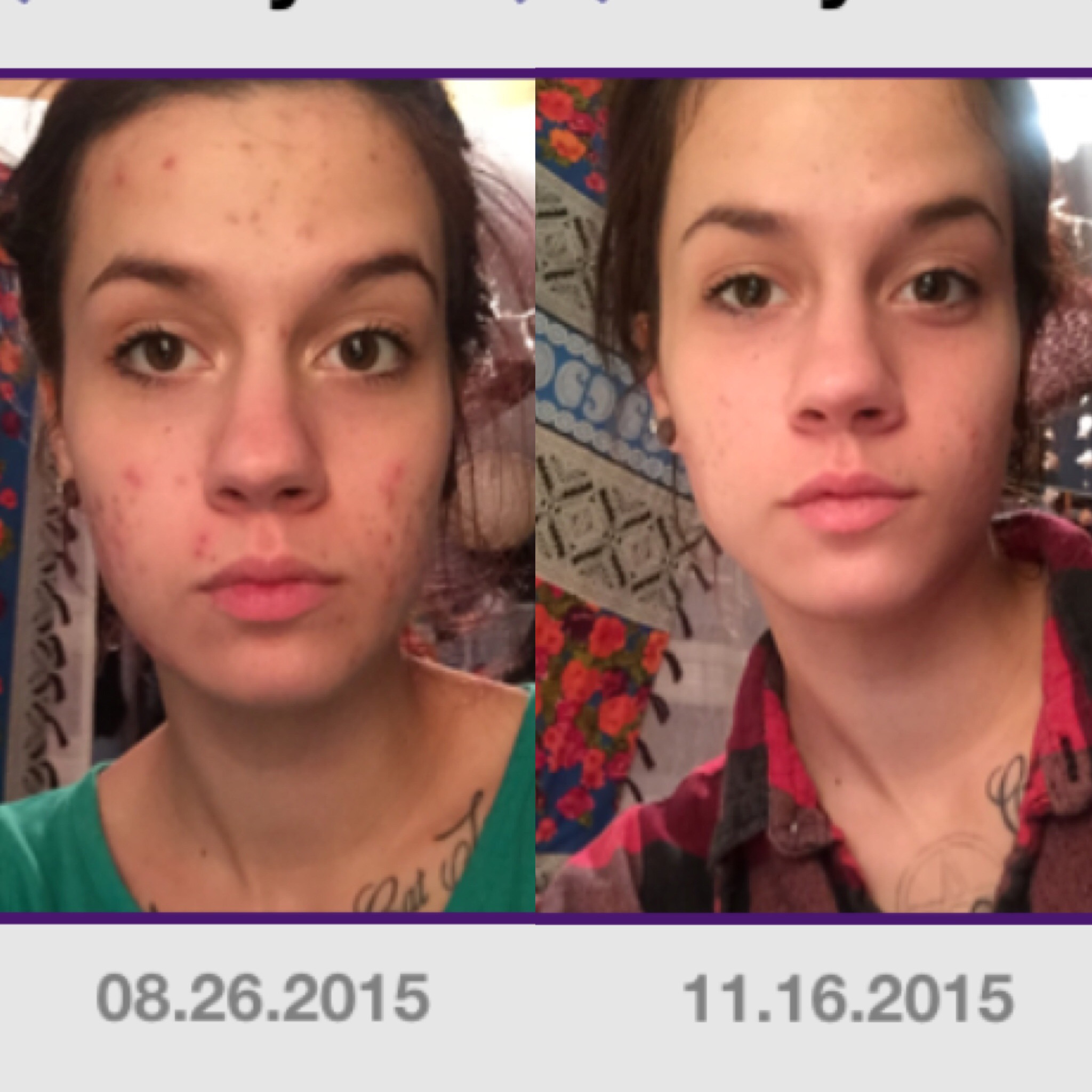 Before & After Hormonal acne by blameitonmygypsysoul