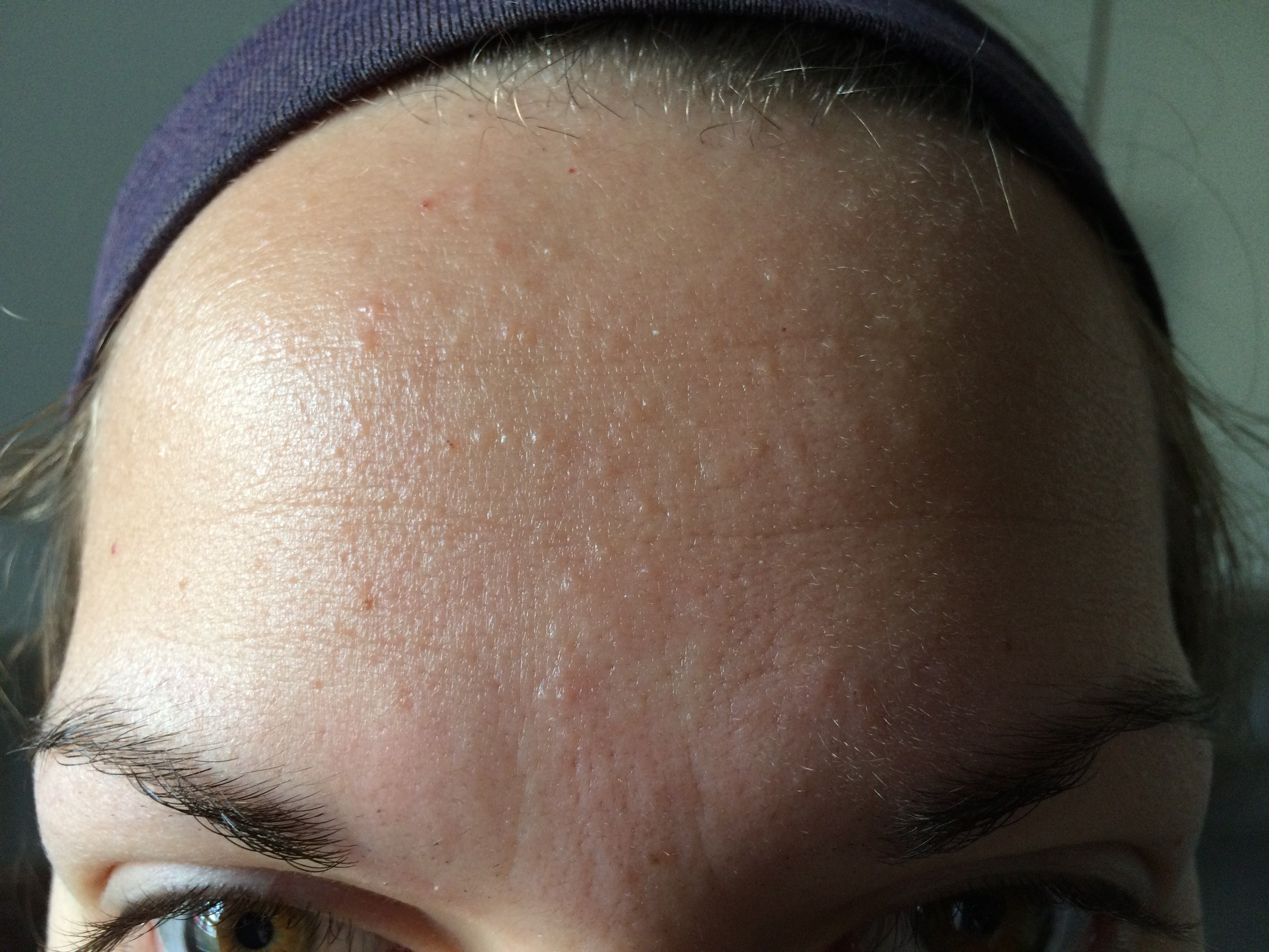 Small Flesh Colored Bumps on Forehead and Hairline Adult acne