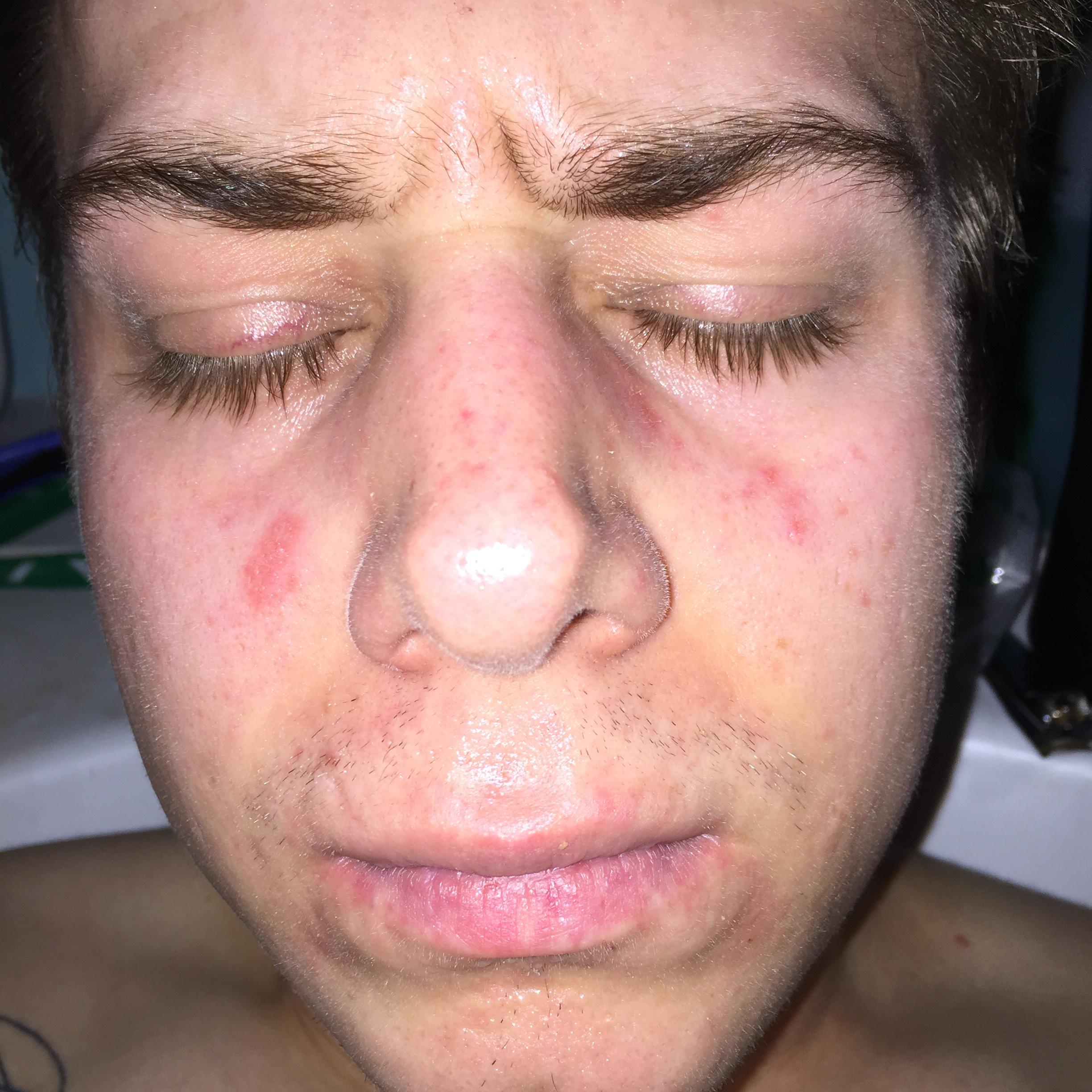 Acne like rash/spots General acne discussion by Andrew Acne like rash/spots General acne discussion by Andrew