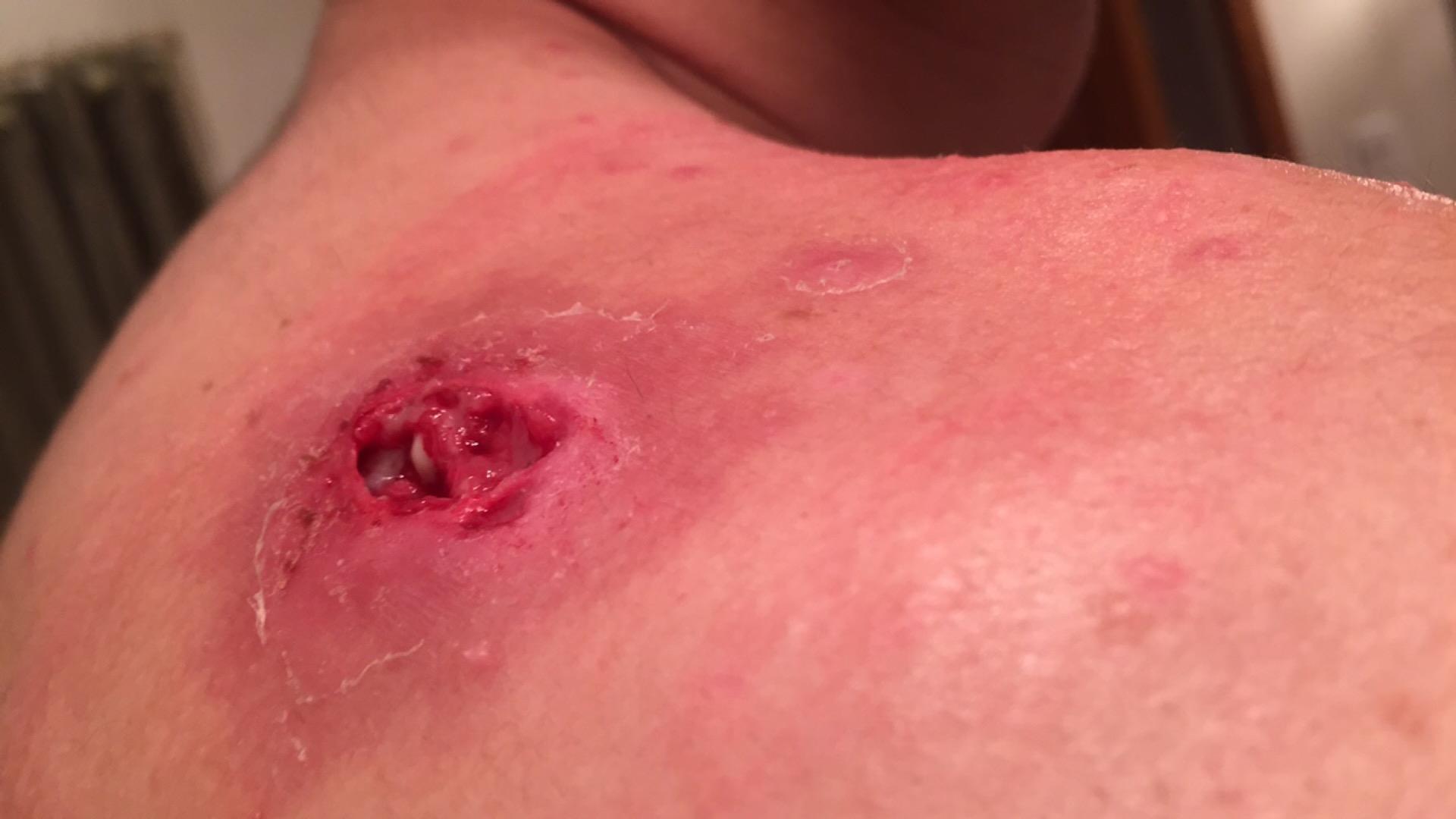 DEEP CRATER FROM CYST Scar treatments Community