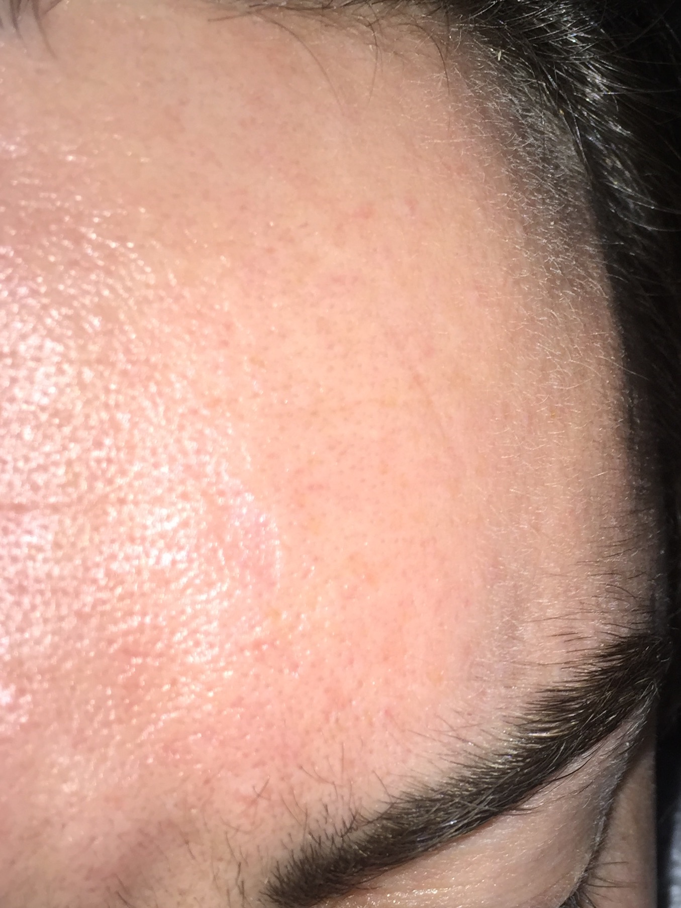 TERRIBLE LARGE PORES General acne discussion by OrangePeel Community
