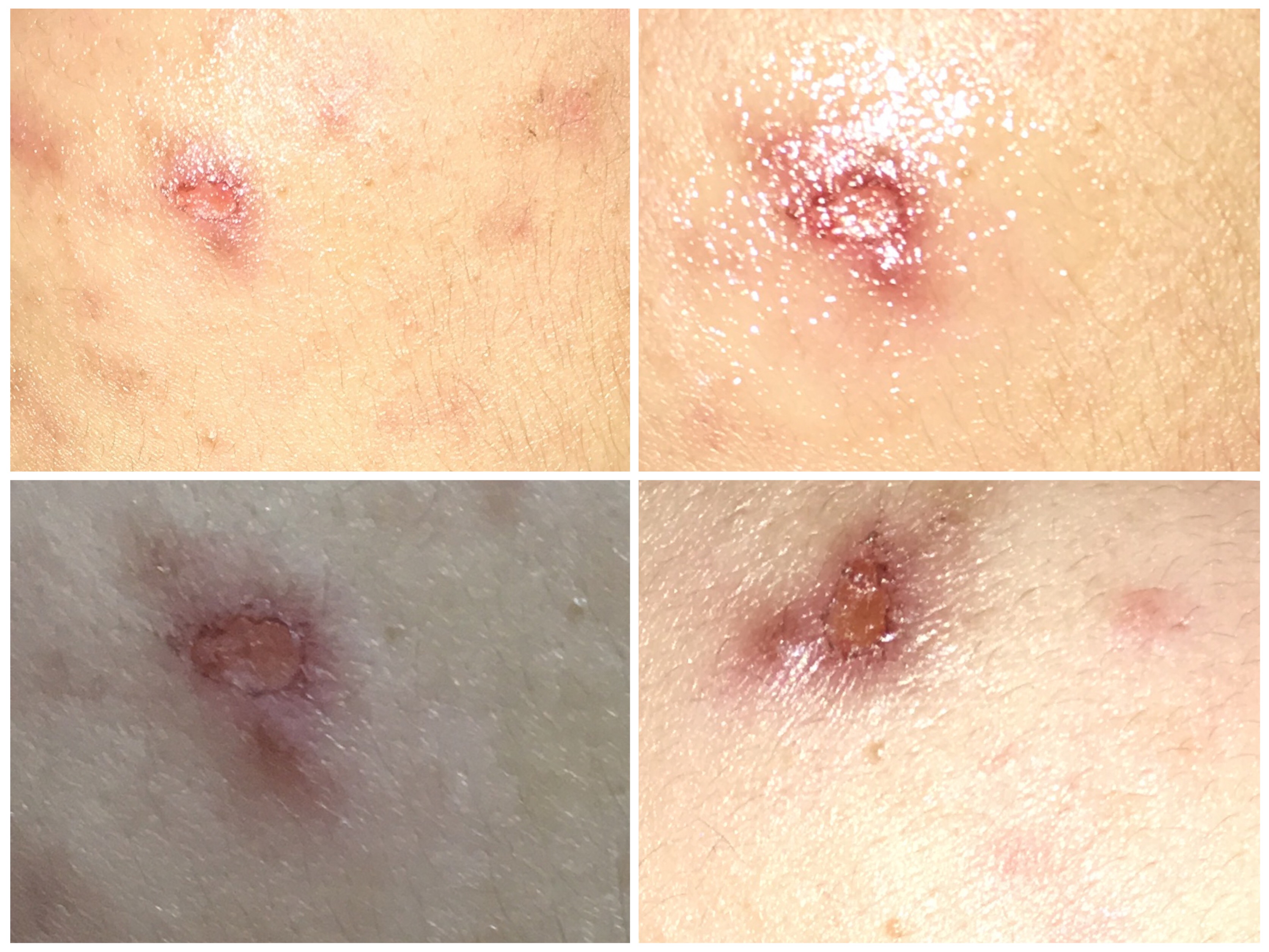 Help!! I need to heal this scar its so embarrassing. Cant Help!! I need to heal this scar its so embarrassing. Cant