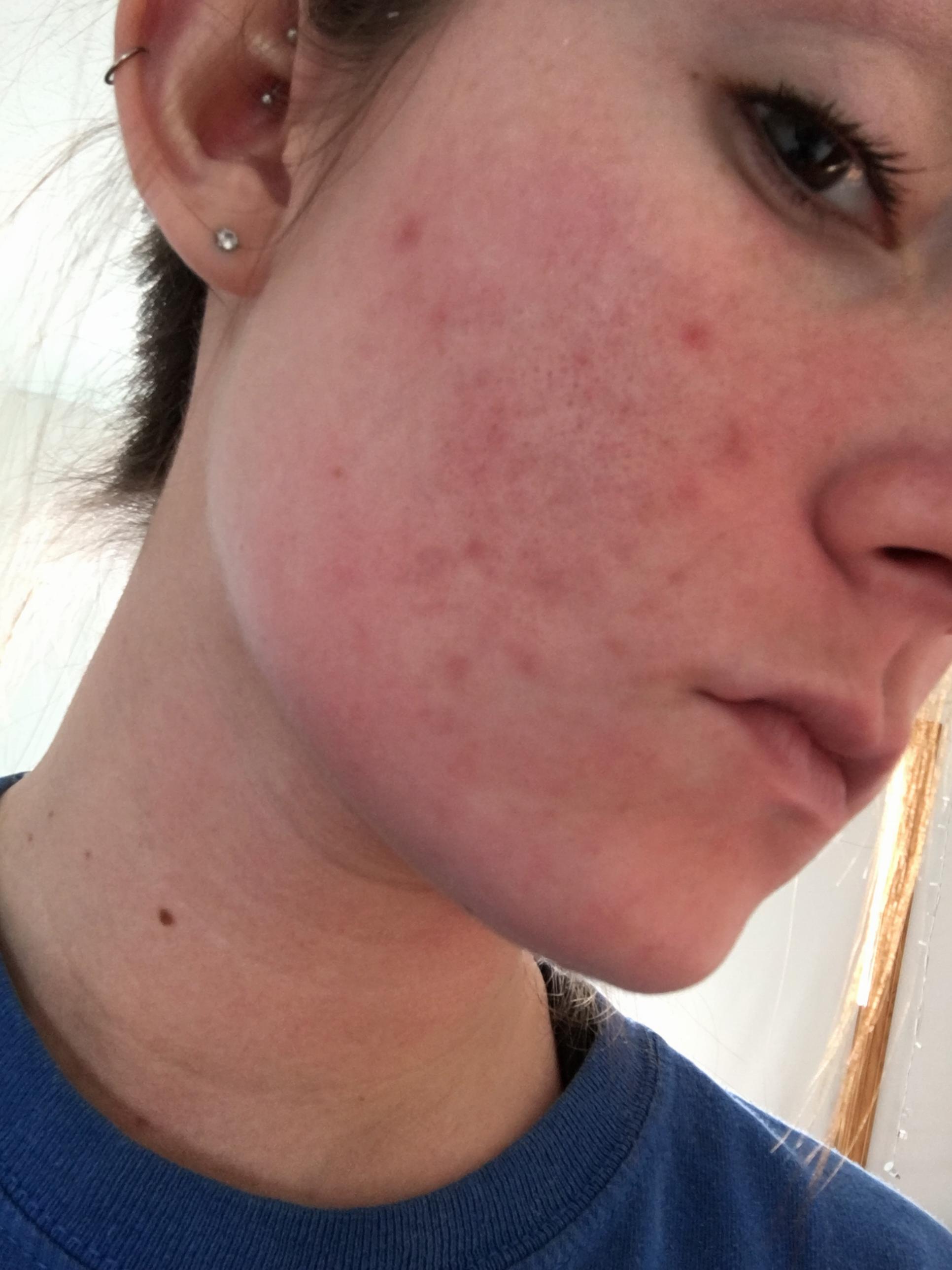 horrible post acne marks Scar treatments