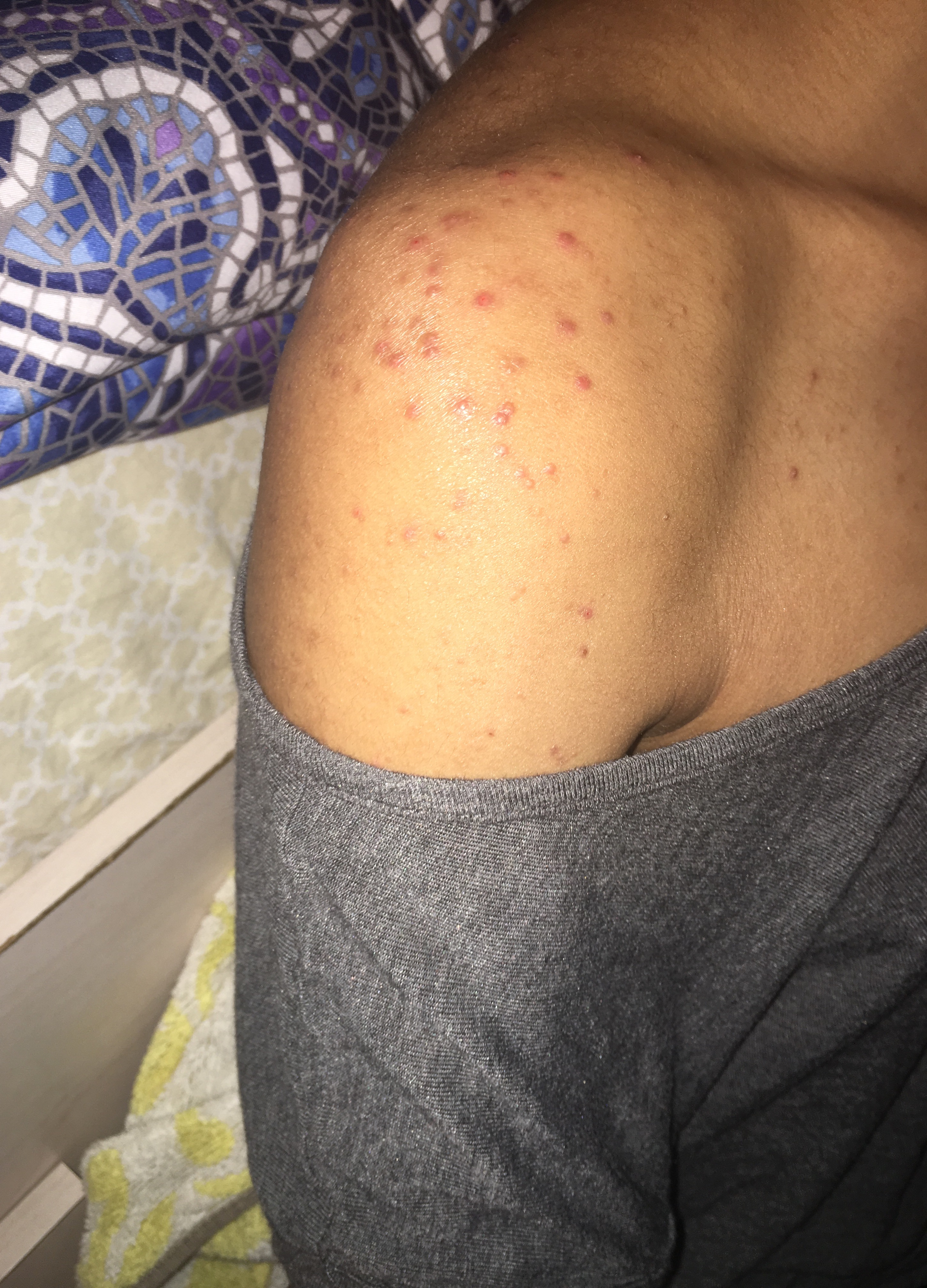 Pesky acne on shoulders hALP Back/Body/Neck acne