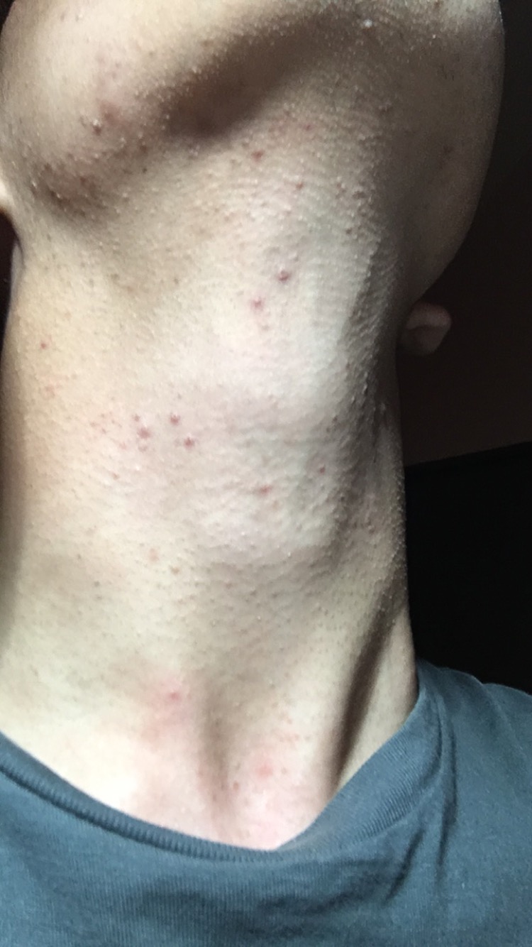 Chronic body acne Back/Body/Neck acne Forum