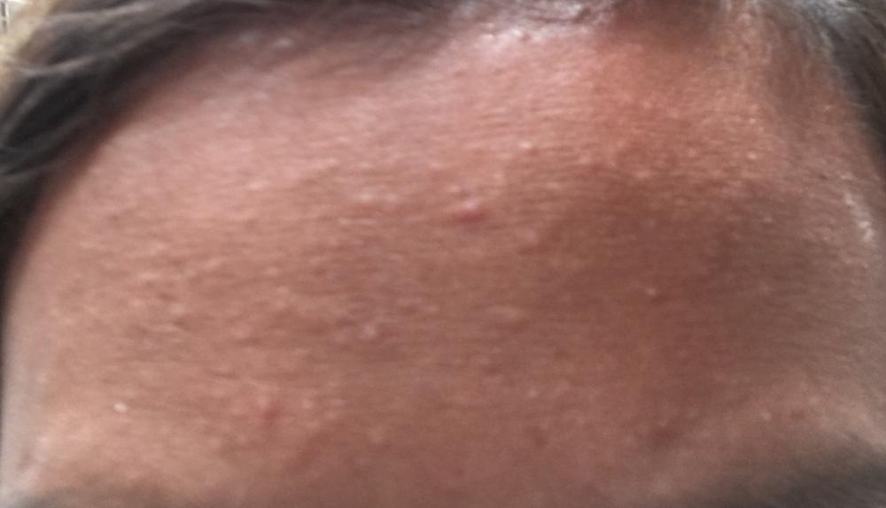 Small bumps on forehead? General acne discussion by