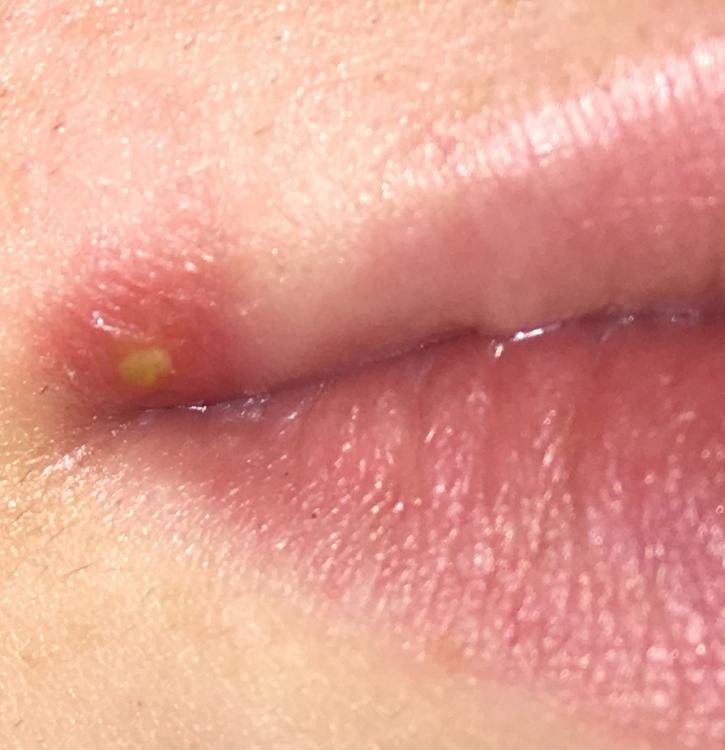 Pimple burns on mouth after popping, how to get rid of it? Other acne