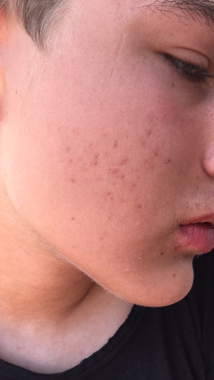 Red marks ruining My Life.. Please help