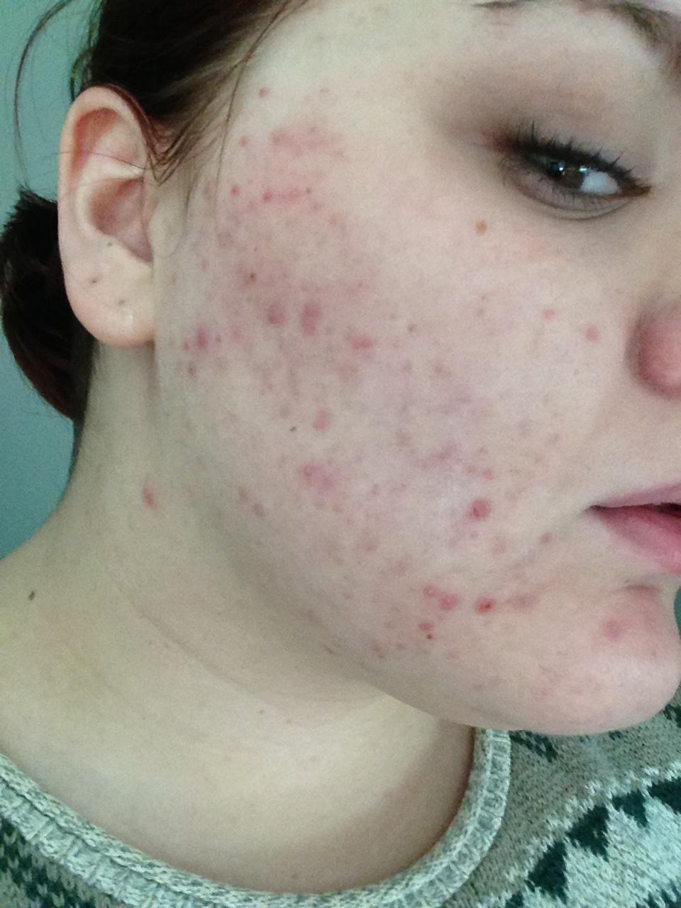 Sudden adult acne? Pcos? Hormonal acne