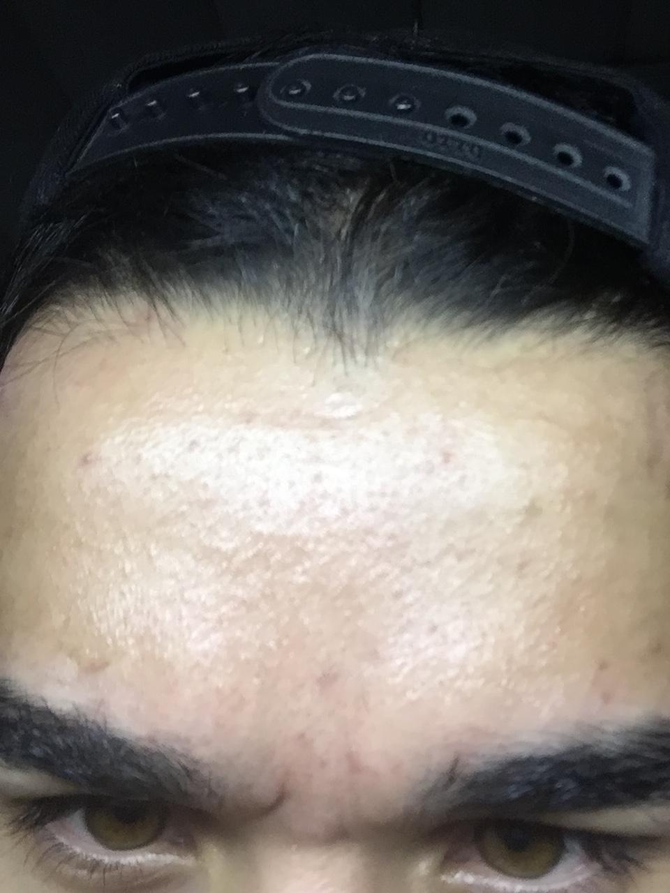 I think I ruined my face with TCA please help!!! Scar