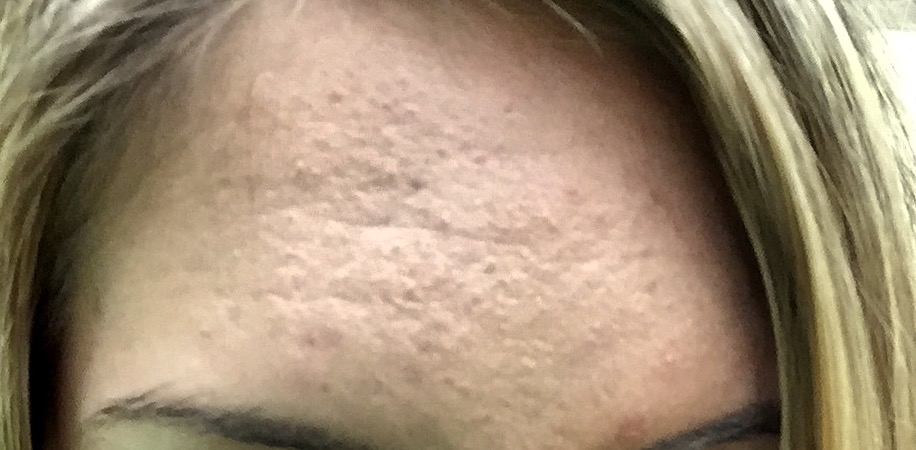 Accutane for subclinical acne (forehead bumps)? Prescription acne