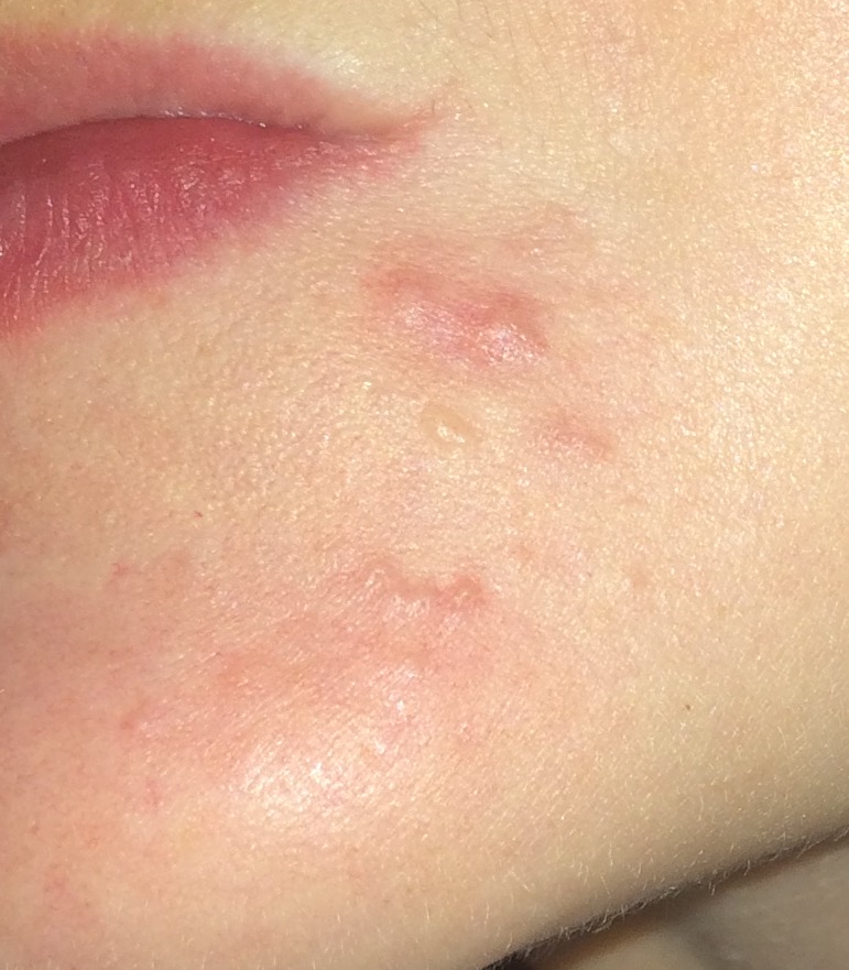 Cortisone Shot (Kenalog Injection) Before & After Pics Personal logs