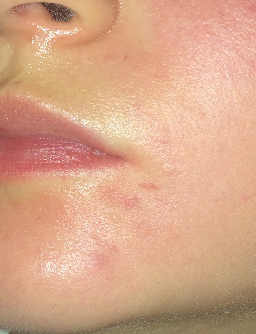 Cortisone Shot (Kenalog Injection) Before & After Pics Personal logs