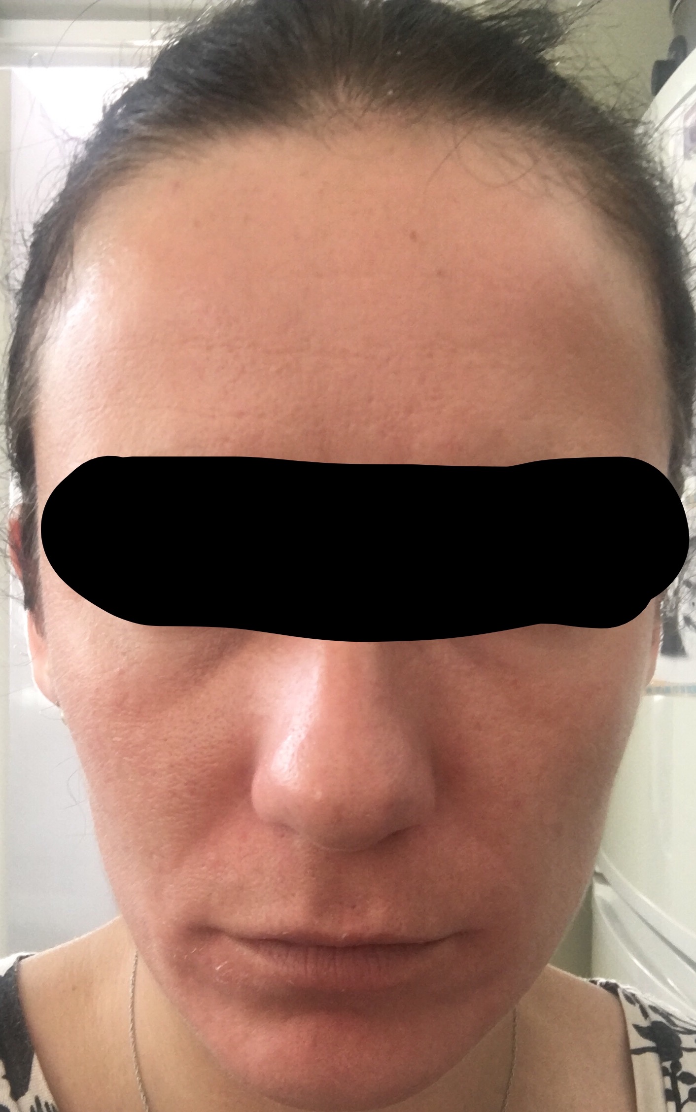 Tretinoin for clogged pores Prescription acne medications