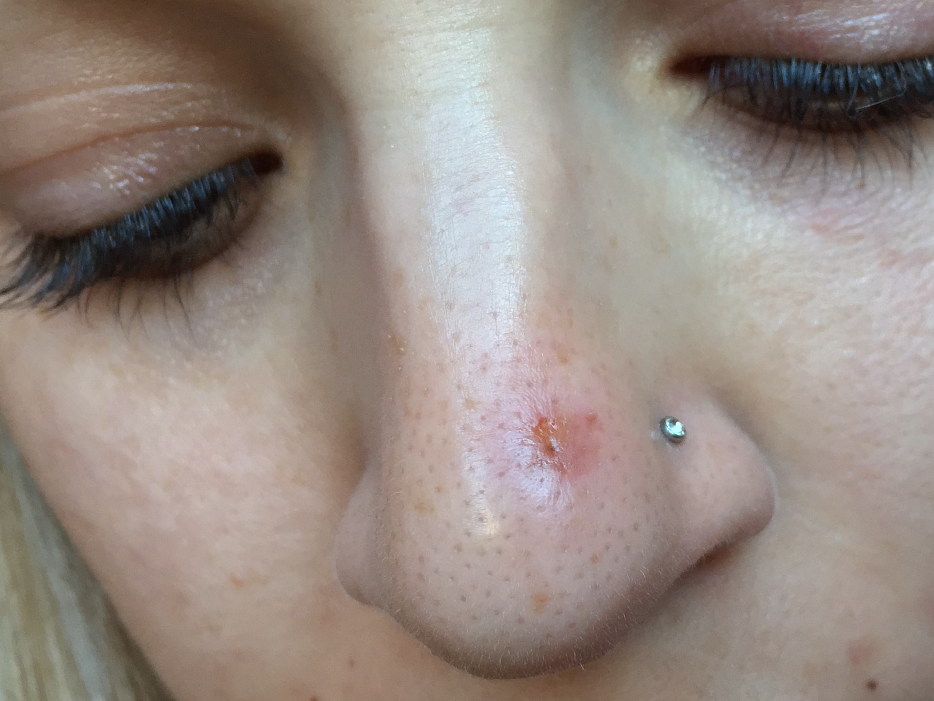 Fast ways to heal an acne scar on nose? Scar treatments Fast ways to heal an acne scar on nose? Scar treatments