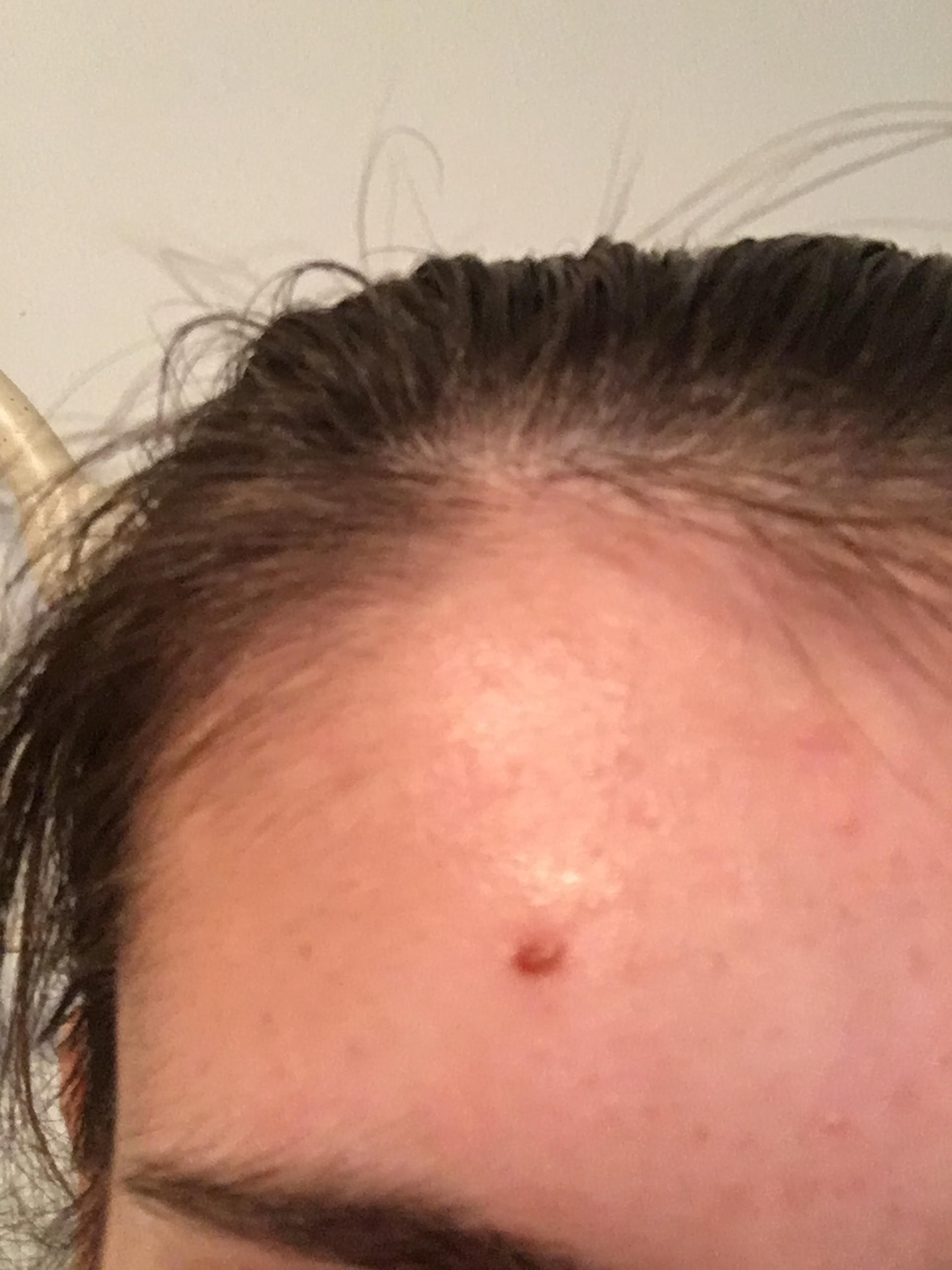 Acne Scab Skin picking Forum
