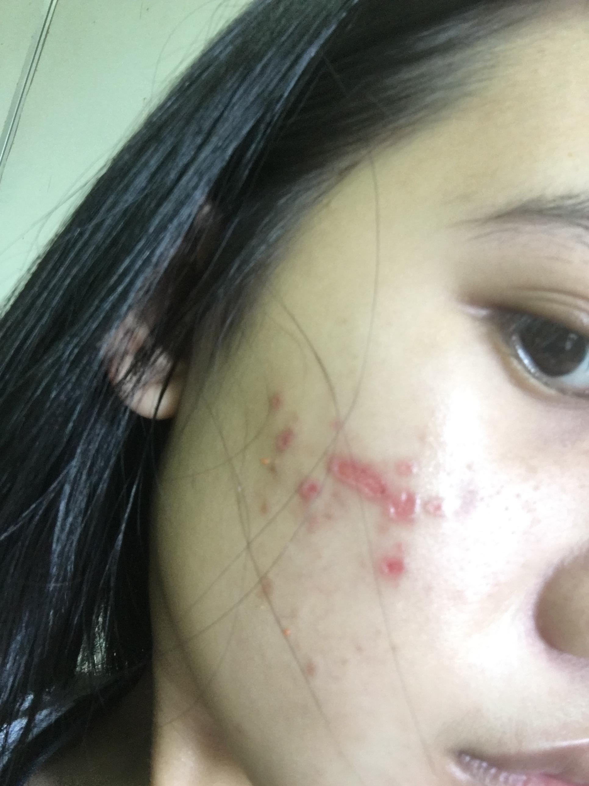 GARLIC BURN Hyperpigmentation red/dark marks by Koala00 Acne