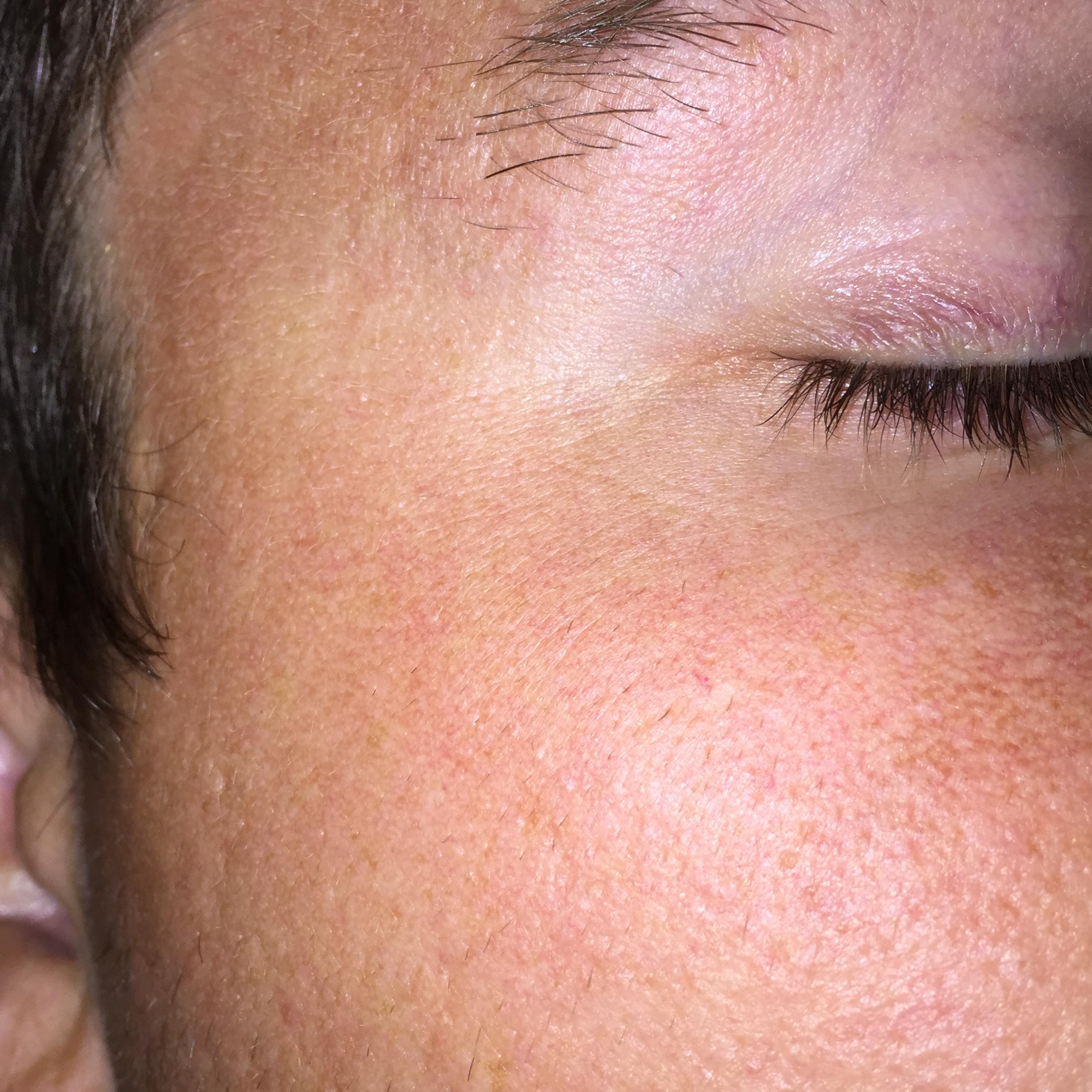 Accutan Horrible texture after! Help! Pics Prescription acne