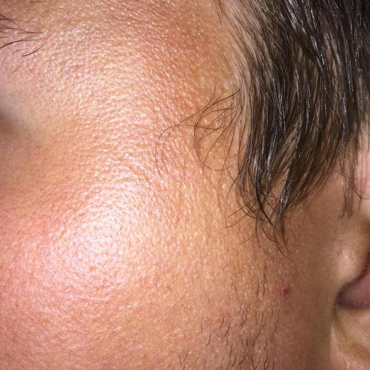 Accutan Horrible texture after! Help! Pics Prescription acne