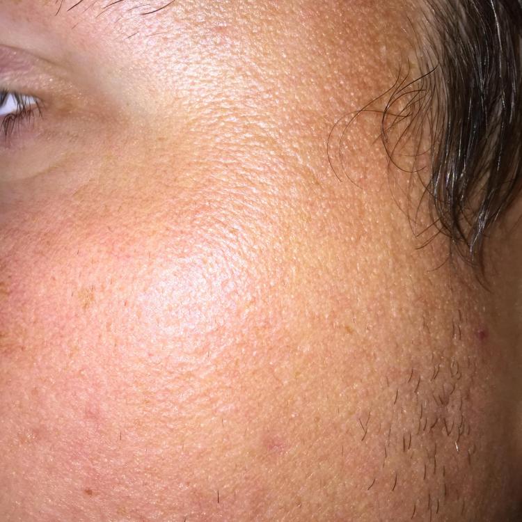 Accutan Horrible texture after! Help! Pics Prescription acne