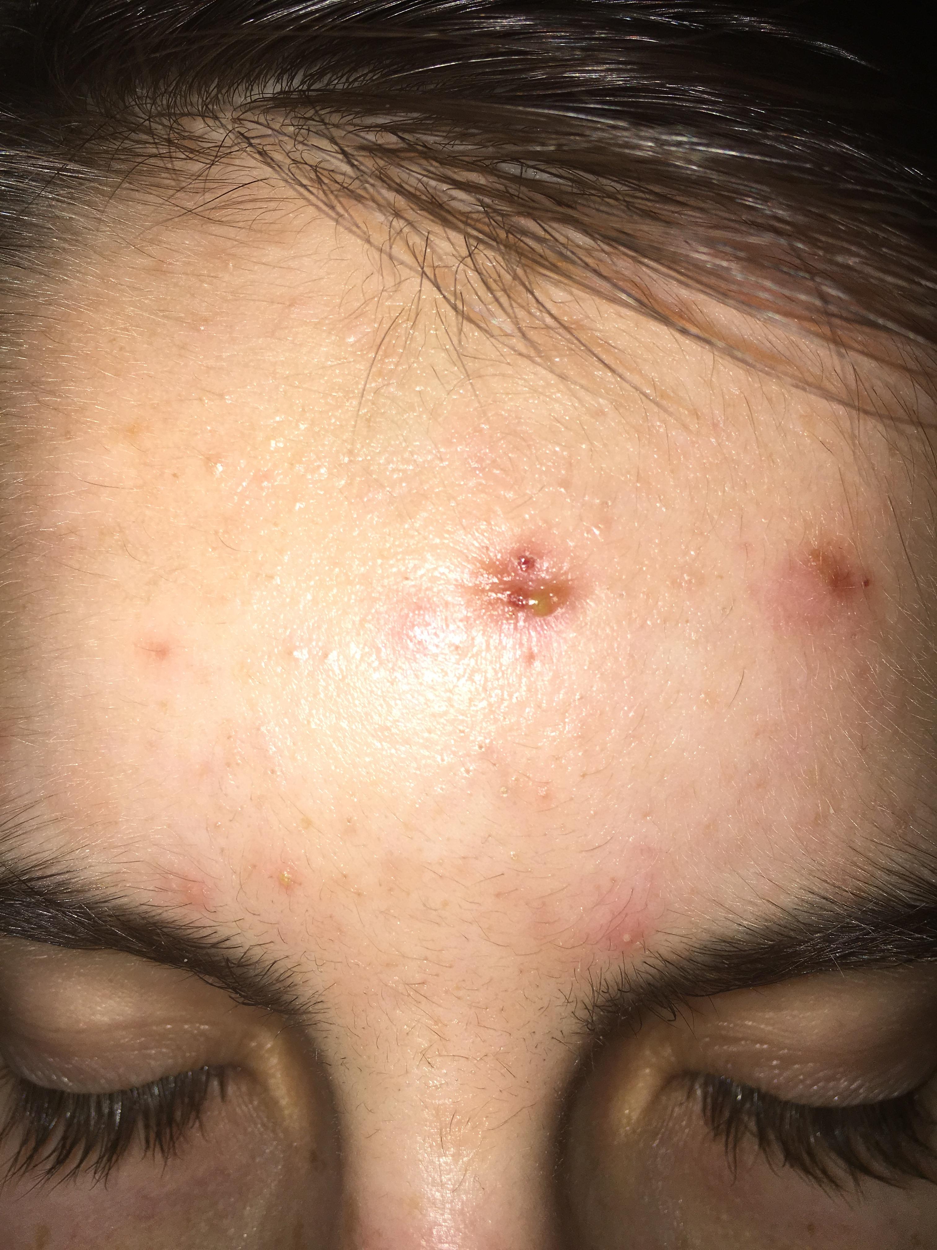 Yellow crust over scab? Skin picking Forum