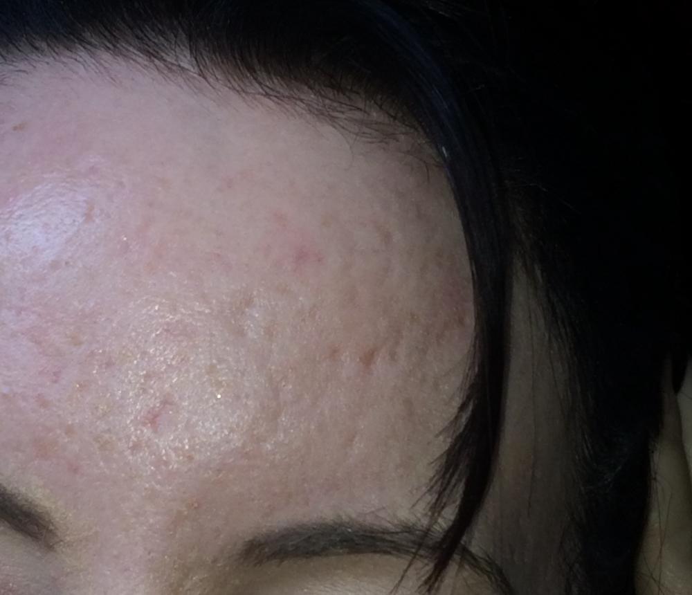 Dermastamp derma rolling results Scar treatments