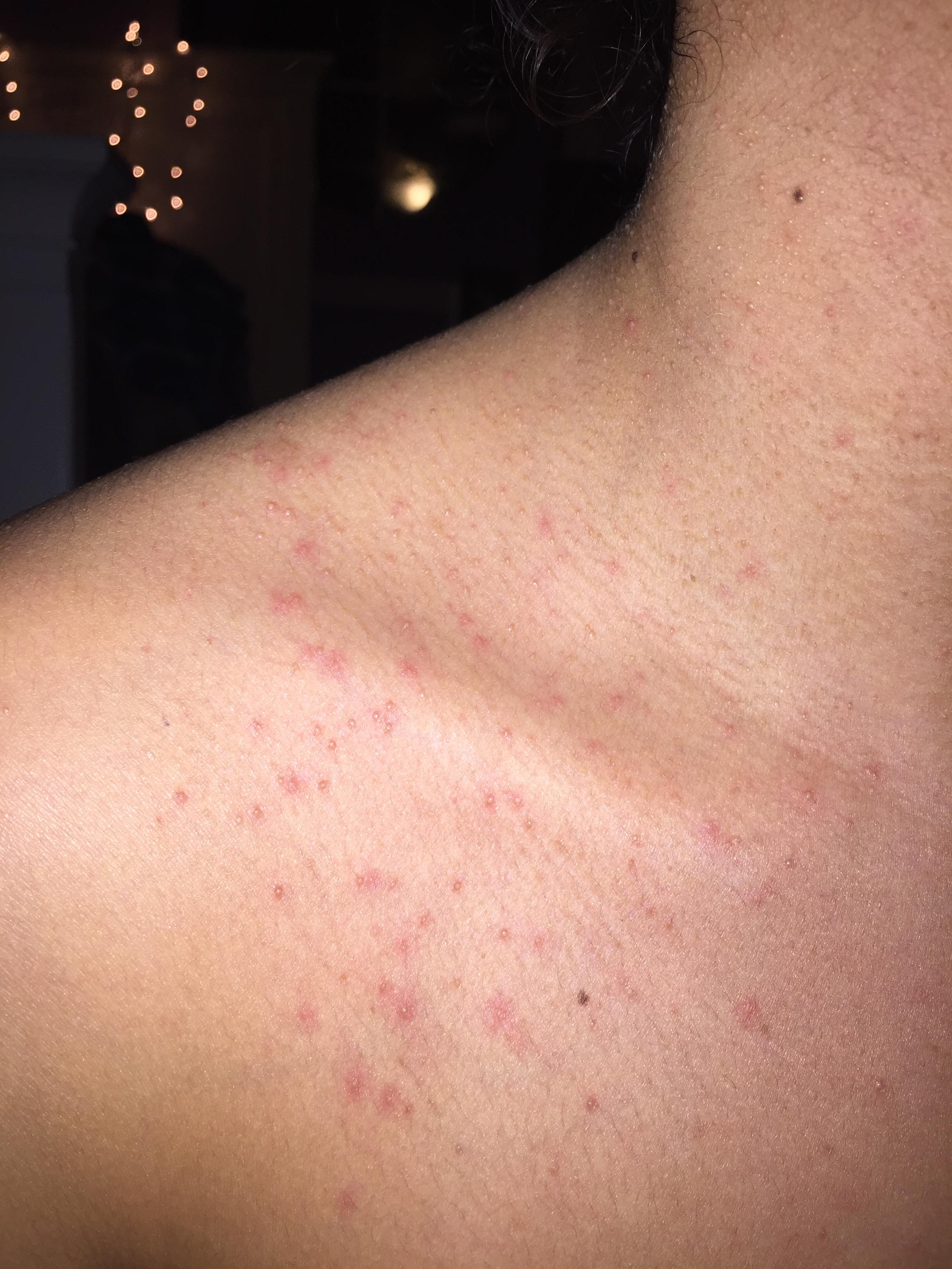 Acne or pityrosporum folliculitis? Back/Body/Neck acne