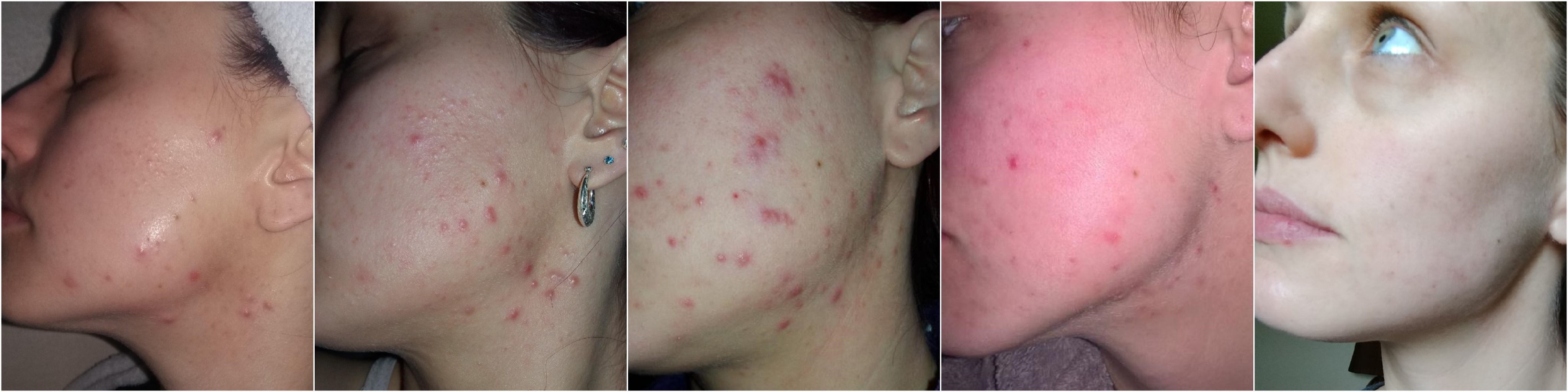 Roaccutane Progress / Progression Pictures. Adult Treatment Resistant